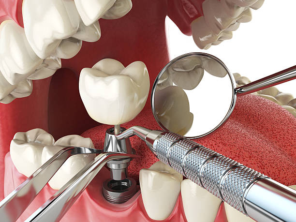 Best Broken or Cracked Tooth Emergency Dentist in Utica, NE